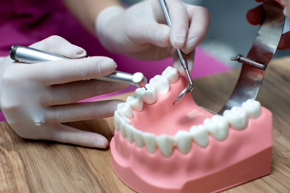 Dentista mostrando en modelo dental el procedimiento de realizar un empaste.